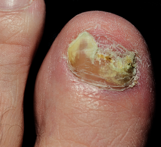 Nail Fungus