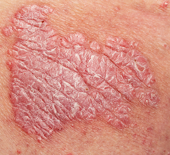 Psoriasis